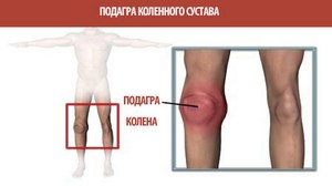 Боли в колене при подагре