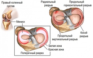 Лечение повреждения коленного сустава