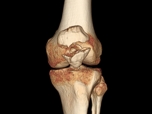 Рентгеновский снимок коленной чашечки