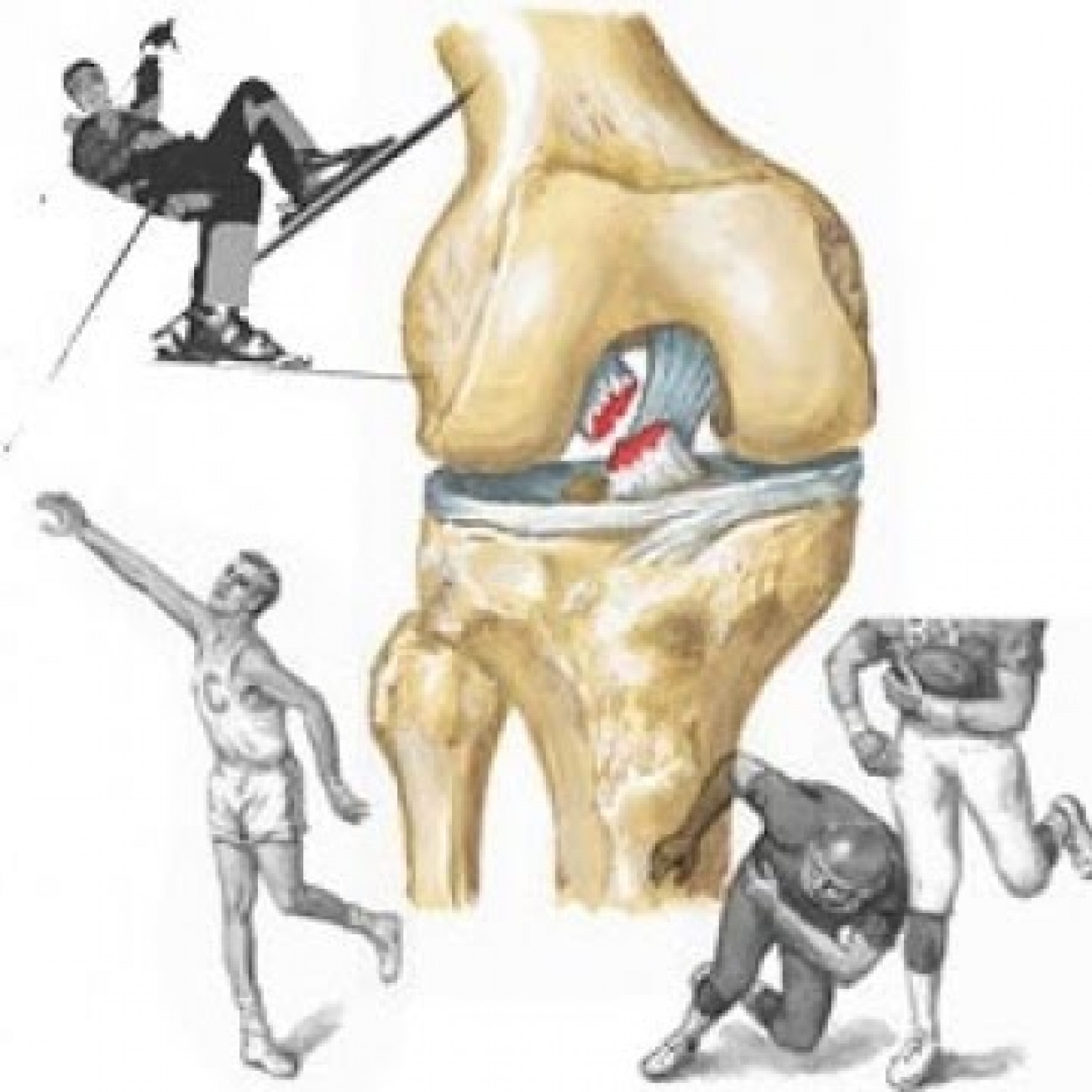 Повреждение коленной связки симптомы. Разрыв связок ПКС коленного сустава. ПКС (передняя крестообразная связка). Травма крестообразной связки коленного сустава. Повреждение ПКС коленного сустава реабилитация.