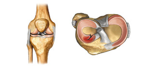 Надрыв мениска коленного сустава