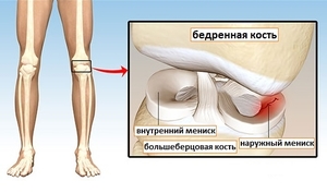 Симптомы мениска коленного сустава