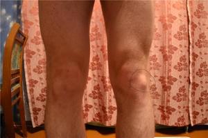 Причины появления шишки на колене