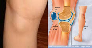 Причины скопления жидкости в колене