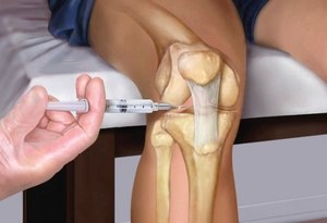 Как делается инъекция в колено