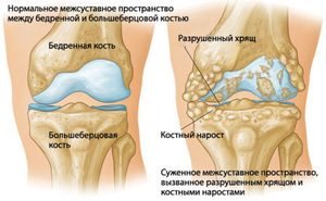 Остеохондроз коленного сустава