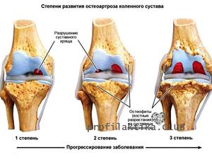 Лечение остеопороза колена