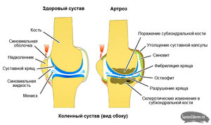 Артроз 3 стадии колена
