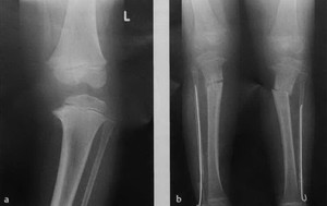 Рентген ног при варусной деформации