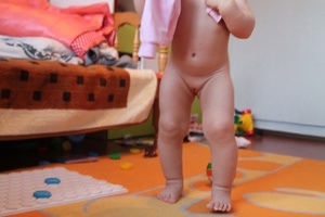 Девочка с варусной деформацией голеней - фото