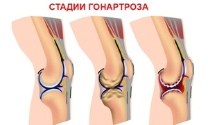 Гоноартроз коленного сустава