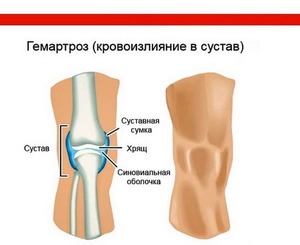 Как вылечить коленный сустав