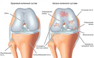 Способы лечения артроза колен