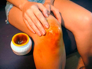 Методы лечения артроза коленей