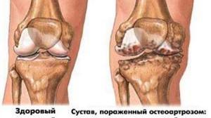 Лечение коленного сустава