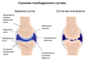 Коксартроз коленного сустава признаки