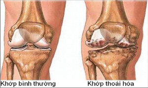 Как лечить кокскартроза коленного сустава