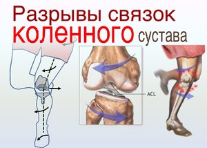 Симптомы разрывов связок коленного сустава