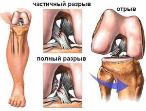 Причины разрыва связок в колене