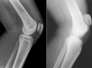 Рентген коленного сустава
