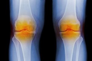Хондроматоз коленного сустава: причины развития заболевания