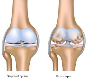 Остеохондроз коленного сустава