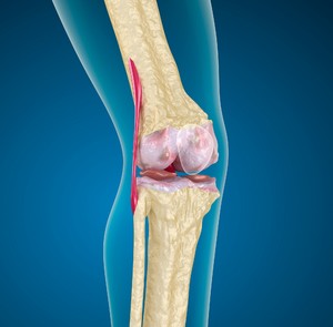 Заболевание коленного сустава на снимке