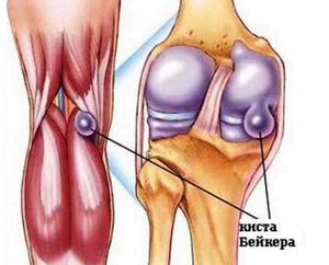Рентгенотерапия на коленный сустав